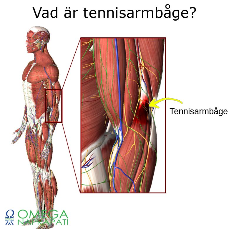Anatomisk illustration av armen där tennisarmbåge, det smärtande senfästet på utsidan av armbågen, är markerat